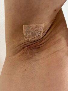 左脇の手術後30日目。中央の赤みがなじんでいき、周囲に薄い皮むけが見られる。