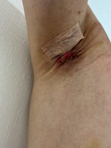 左脇の手術後13日目。創部に赤い肉芽が見え、周囲はやや色素沈着している。