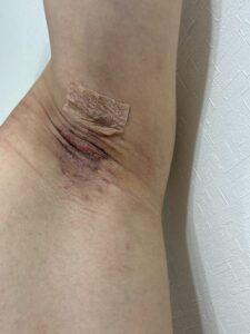 右脇の手術後13日目。赤みと軽い隆起が見られる。