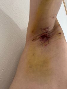 右脇の手術後6日目。縫合部周囲の内出血が徐々に軽減。腫れも軽減傾向。