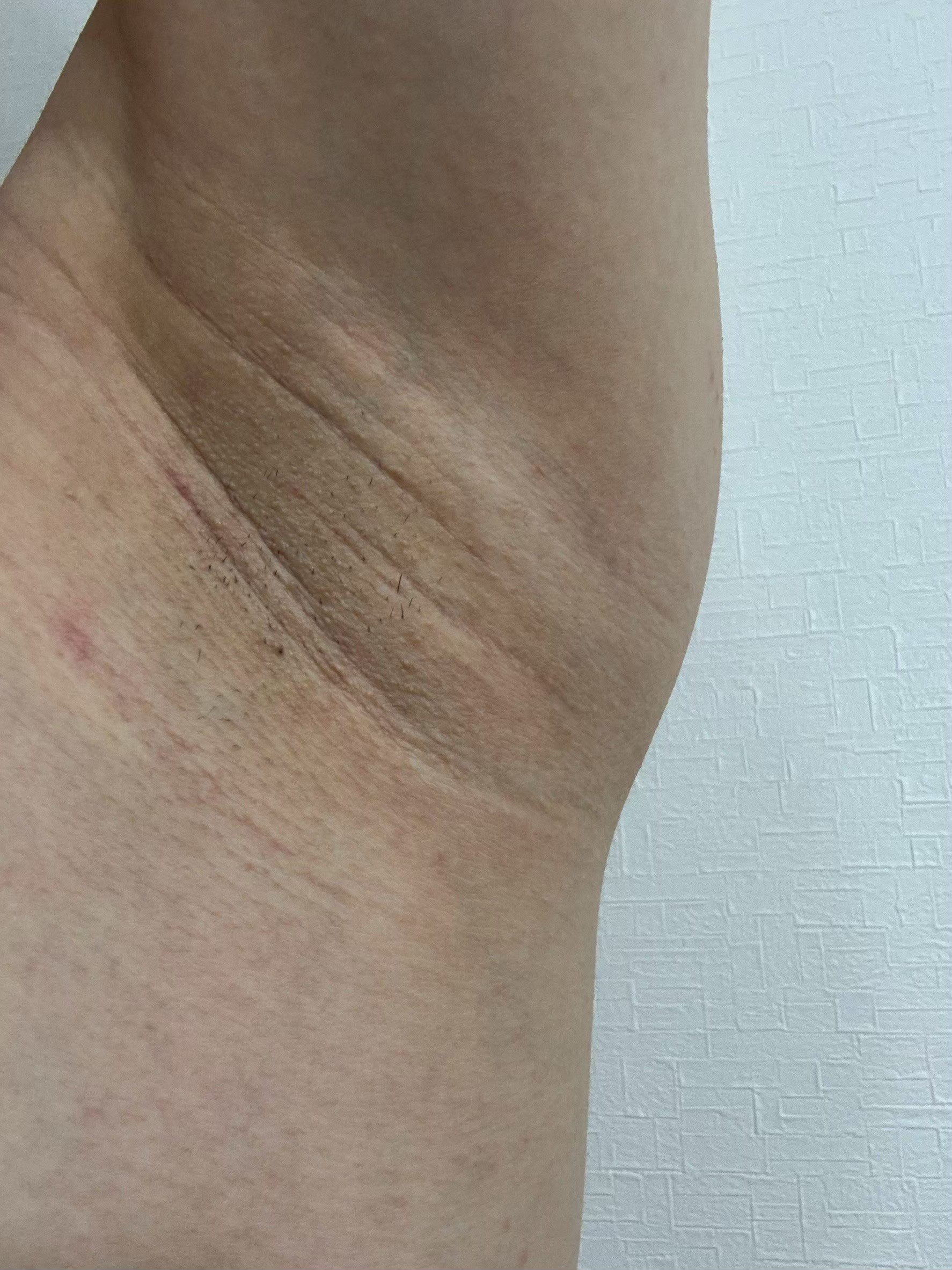 左脇の手術前状態。皮膚は比較的均一で、剃った毛が見られる。