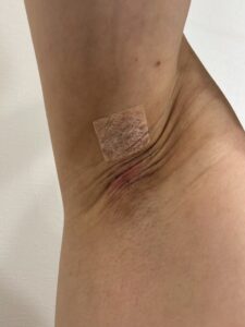 左脇の手術後28日目。中央に軽い赤み。赤みと軽い腫れが持続し、周囲に薄い皮むけが見られる。
