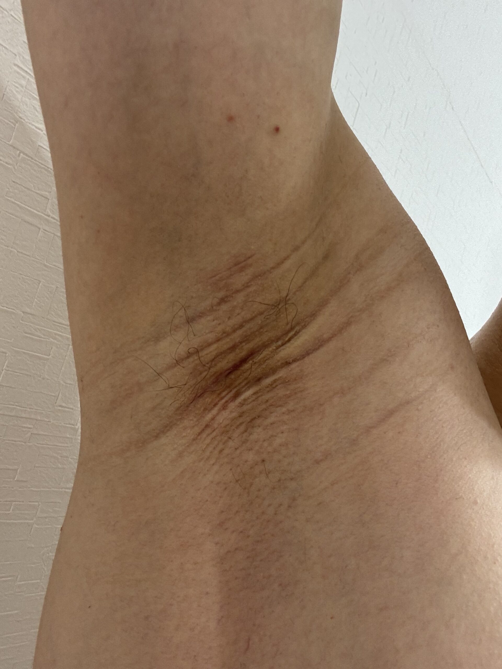 右脇の手術後163日目。切開痕は非常に薄く、周囲の皮膚とほぼ同化している。