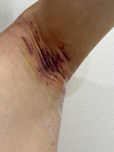 左脇の手術後2日目。紫色の内出血と腫れが持続している。