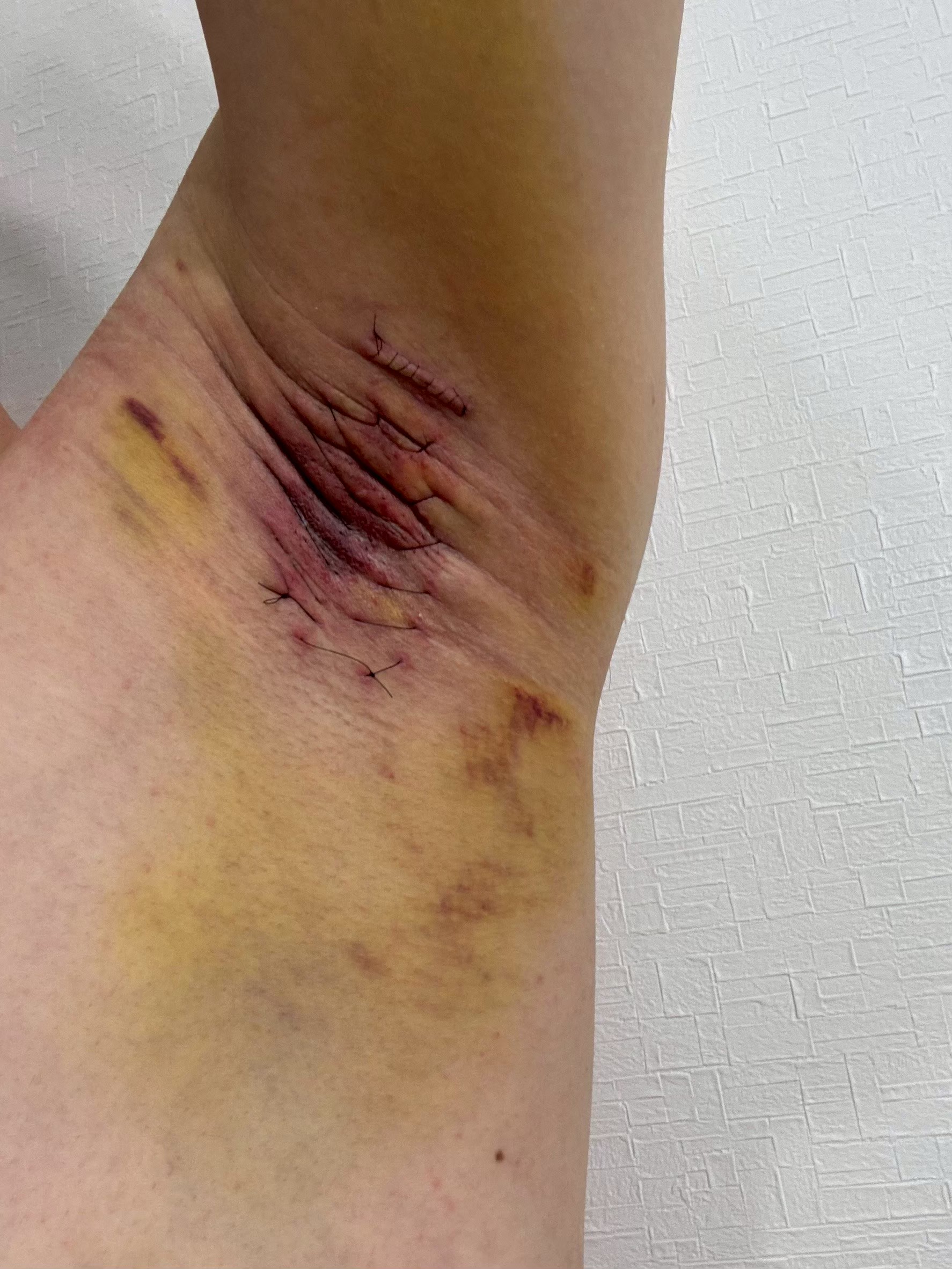左脇の手術後5日目。腫れはやや落ち着き、内出血の色が薄くなる傾向。
