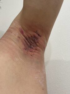 左脇の手術後1日目。縫合部と周囲に赤みと軽度の腫れ、内出血が見られる。