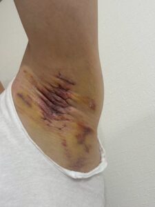左脇の手術後3日目。広範囲に黄色～紫色の内出血が見られる。