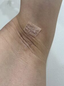 右脇の手術後34日目。盛上りがなじんでいく様子。