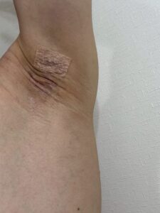 右脇の手術後17日目。赤みが薄れつつあり、周囲は正常に近い状態。