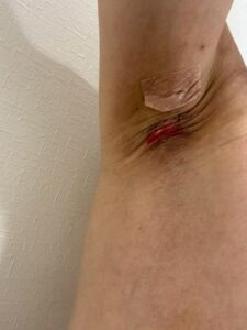 左脇の手術後16日目。創部は縮小し、赤みが残るものの表面は乾いている。