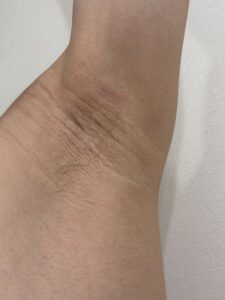 右脇の手術後139日目。傷はほぼ目立たず、しわに溶け込んだ状態。