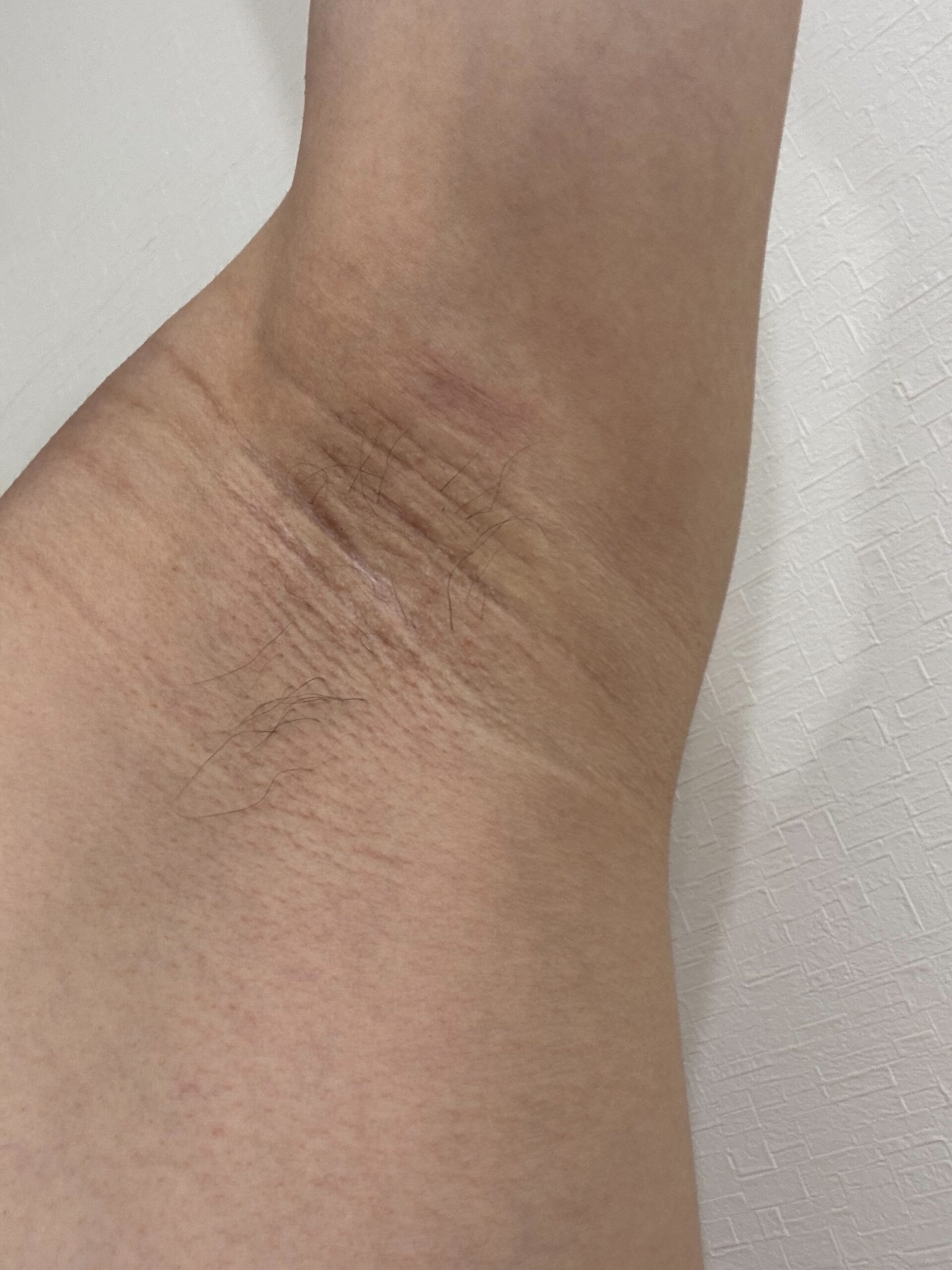左脇の手術後139日目。傷はほぼ目立たず、しわに溶け込んだ状態。