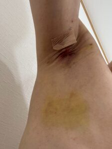 右脇の手術後8日目。創部は落ち着き、内出血の色がさらに薄くなっている。