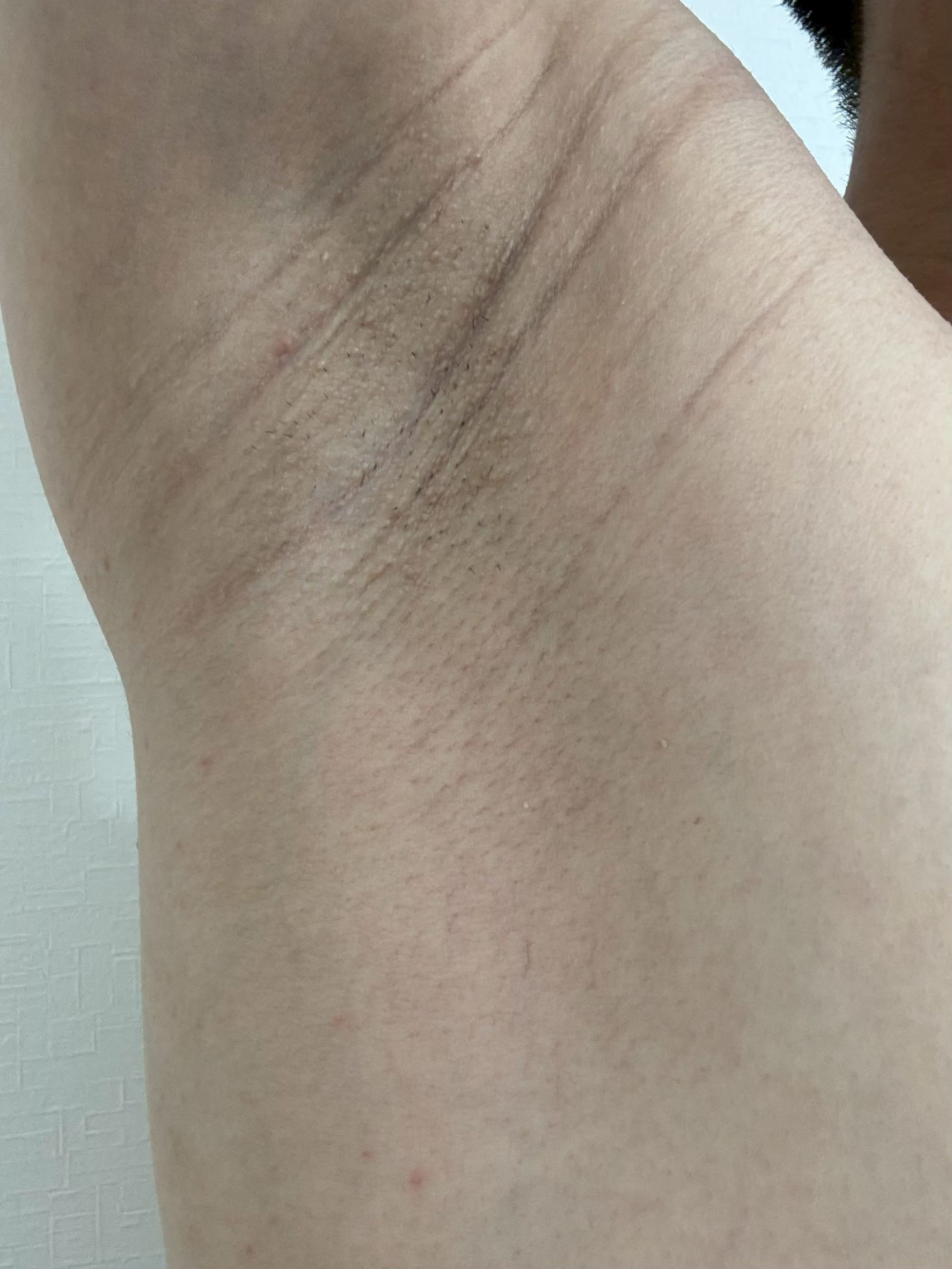 右脇の手術前状態。皮膚は比較的均一で、剃った毛が見られる。