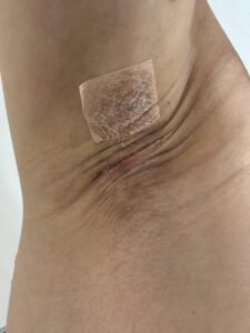 左脇の手術後31日目。中央に細い赤みが残るが、全体は落ち着いた状態。