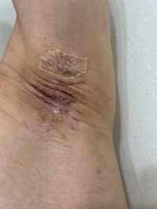 右脇の手術後12日目。前日まで創部は落ち着いていたが、急にかさぶた様になる。