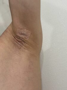 右脇の手術後16日目。かさぶたの剥けた後の淡いピンク感になる。