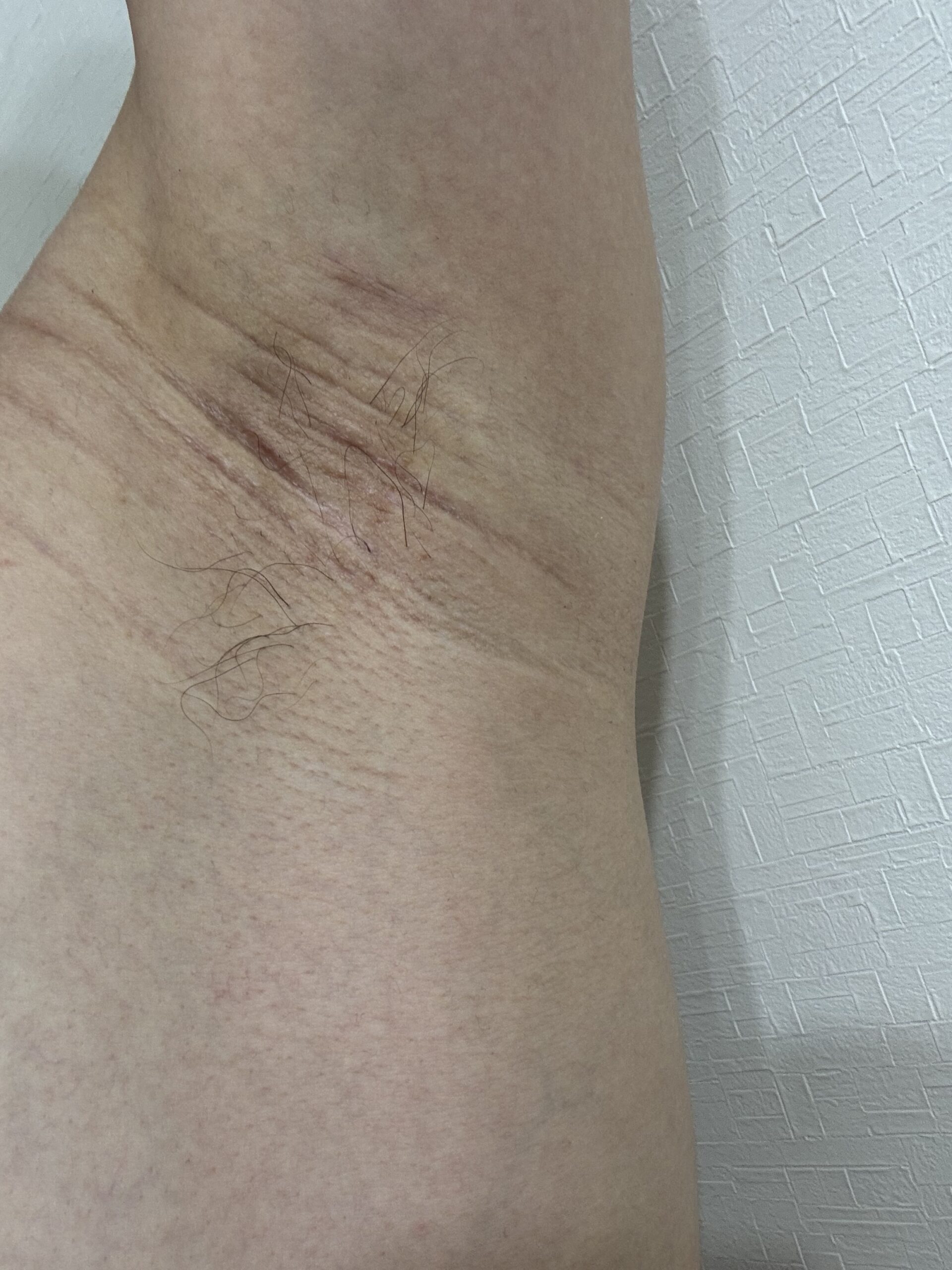 左脇の手術後163日目。傷跡はほぼ消失に近く、自然な皮膚のしわとして見える。