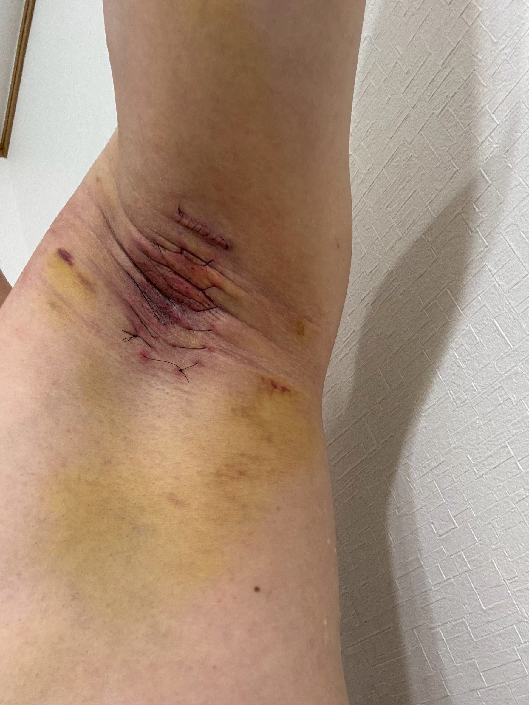 左脇の手術後6日目。縫合部周囲の内出血が徐々に軽減。腫れも軽減傾向。