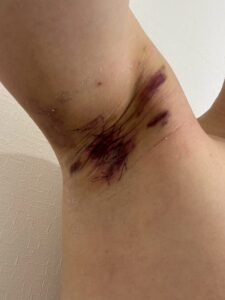 右脇の手術後2日目。紫色の内出血と腫れが持続している。