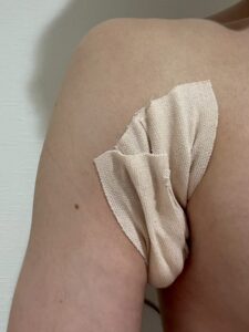 右脇の手術直後。ガーゼで圧迫固定されている状態。