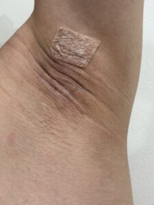 右脇の手術後30日目。盛上りがなじんでいく様子。